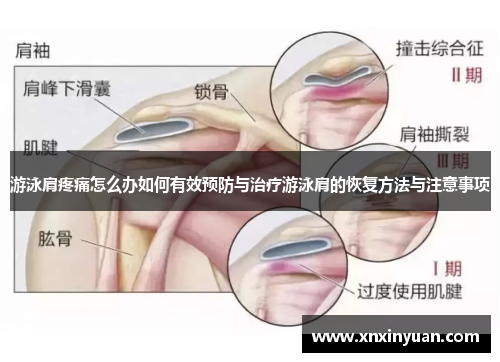 游泳肩疼痛怎么办如何有效预防与治疗游泳肩的恢复方法与注意事项